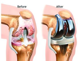 تعویض مفصل زانو (آرتروپلاستی زانو) Total Knee